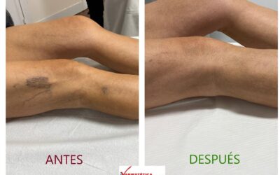 Esclerosis con microespuma variestetica antes y despues 4 Arañas vasculares en las piernas: causas y tratamiento en Málaga